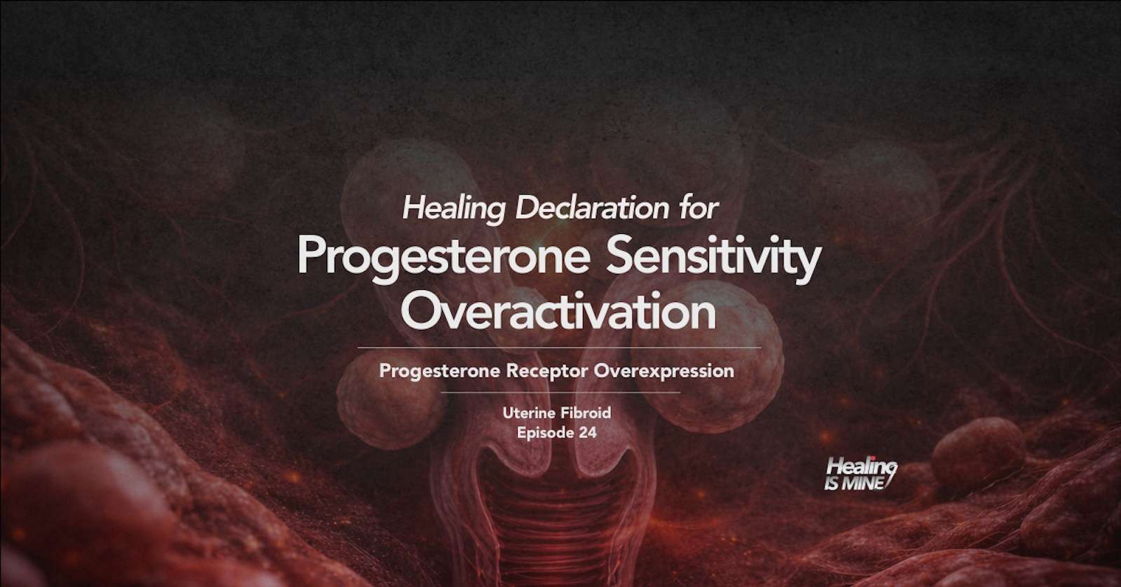 Multiple uterine fibroid nodules within uterine wall representing progesterone sensitivity overactivation (progesterone receptor overexpression) in fibroid tissue
