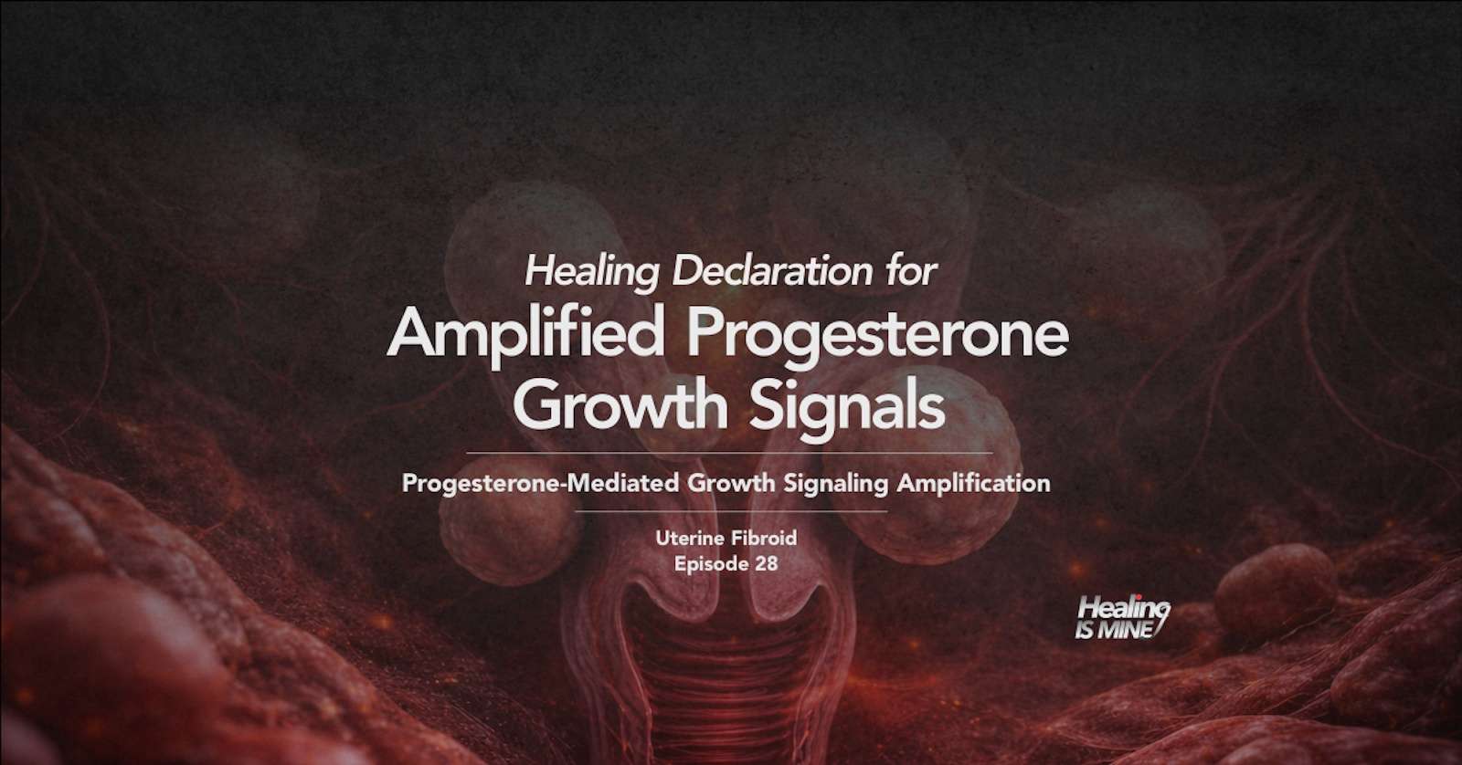 Multiple uterine fibroid masses within uterine wall illustrating amplified progesterone growth signals (progesterone-mediated growth signaling amplification)