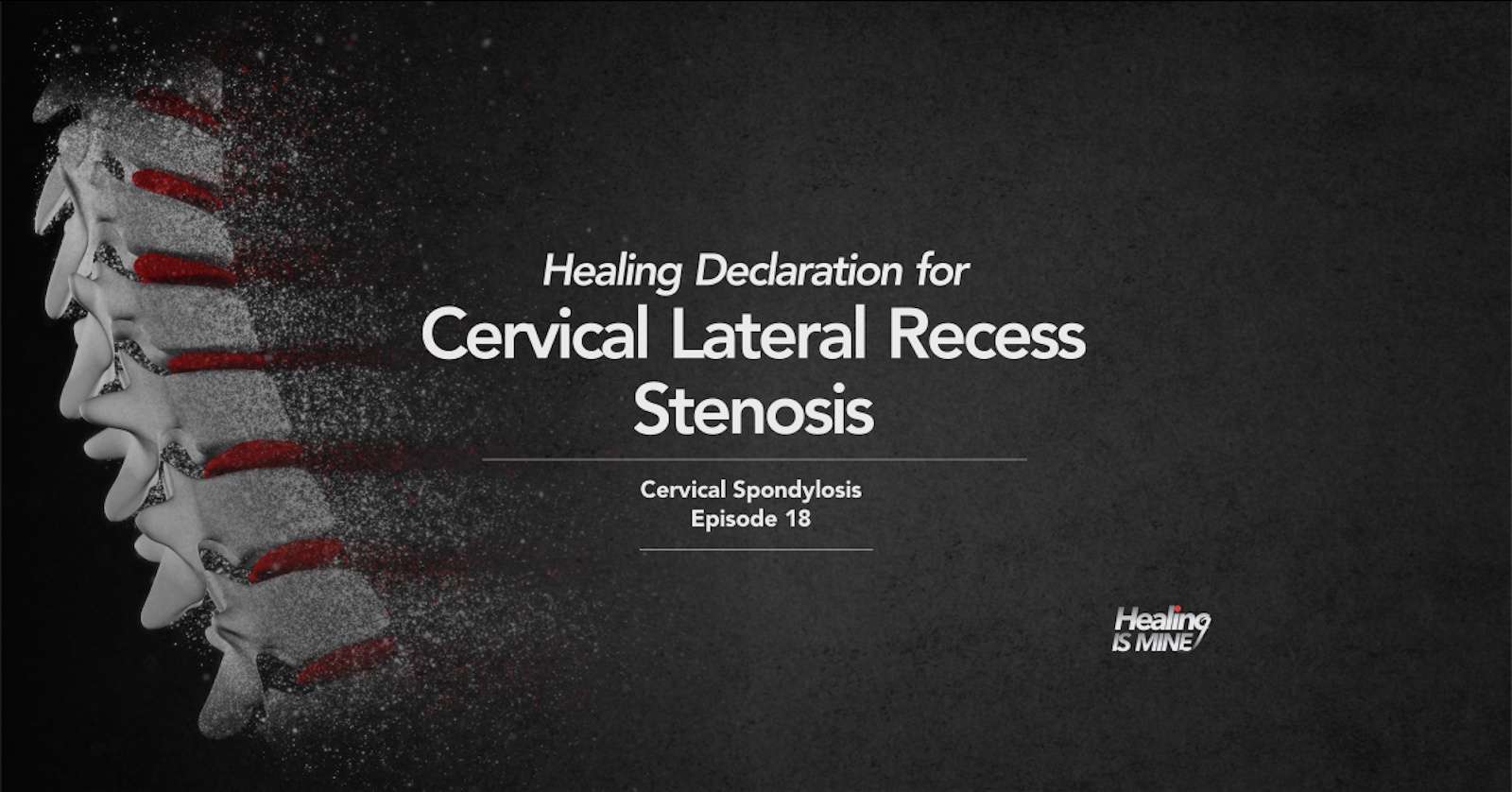 Cervical lateral recess stenosis narrowing spinal nerve pathway in cervical spine illustration