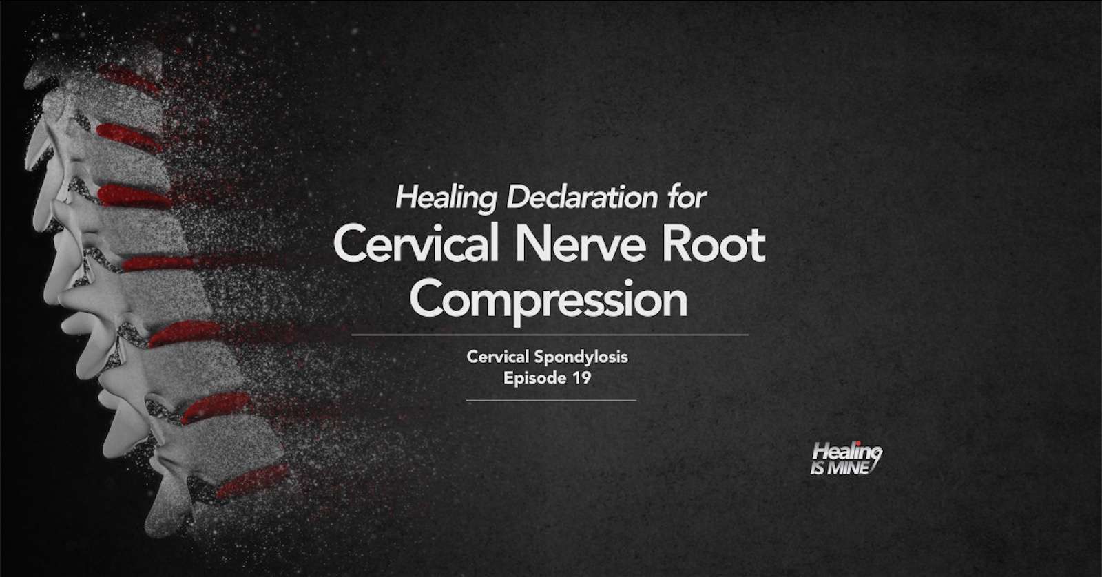 Illustration of cervical spine vertebrae with narrowed neural foramen compressing a cervical nerve root in cervical spondylosis