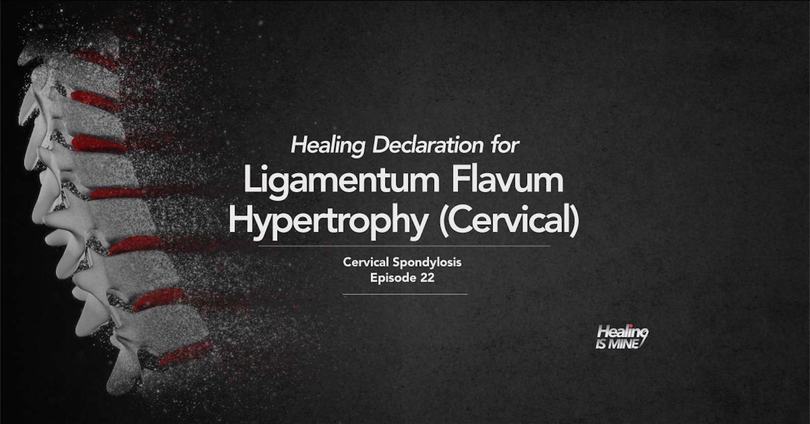 Cervical spine illustration showing thickened ligamentum flavum narrowing the spinal canal in cervical spondylosis